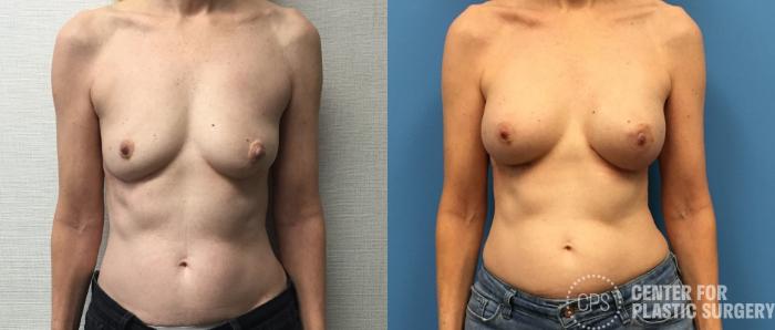 Breast Reconstruction Case 313 Before & After Front | Chevy Chase & Annandale, Washington D.C. Metropolitan Area | Center for Plastic Surgery