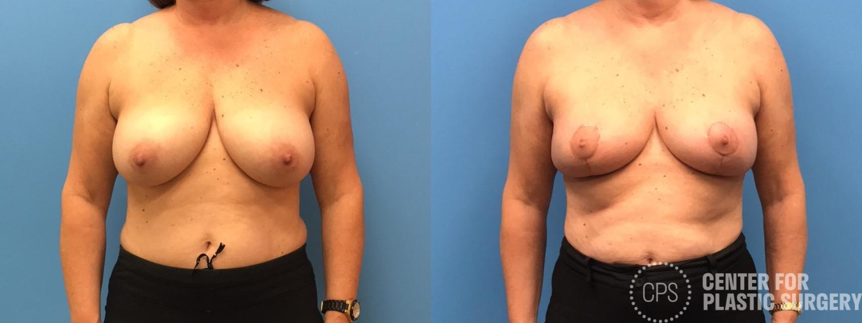 Breast Reconstruction Case 314 Before & After Front | Chevy Chase & Annandale, Washington D.C. Metropolitan Area | Center for Plastic Surgery