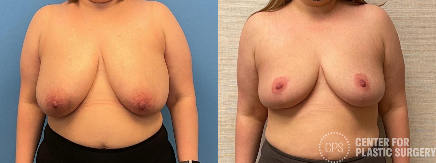 Breast Reconstruction Case 315 Before & After Front | Chevy Chase & Annandale, Washington D.C. Metropolitan Area | Center for Plastic Surgery