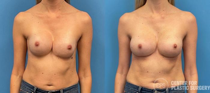 Breast Reconstruction Case 317 Before & After Front | Chevy Chase & Annandale, Washington D.C. Metropolitan Area | Center for Plastic Surgery