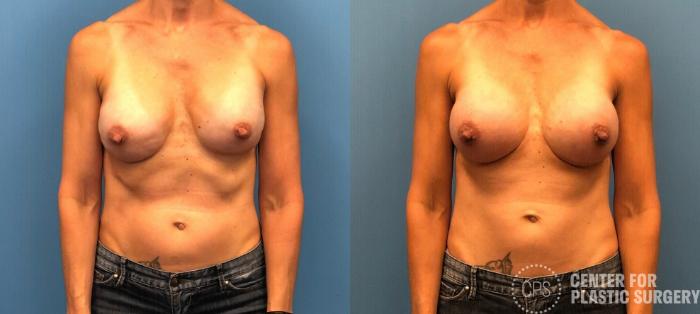 Breast Reconstruction Case 318 Before & After Front | Chevy Chase & Annandale, Washington D.C. Metropolitan Area | Center for Plastic Surgery