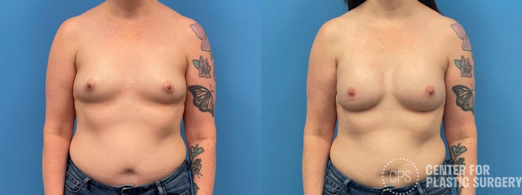 Breast Reconstruction Case 335 Before & After Front | Chevy Chase & Annandale, Washington D.C. Metropolitan Area | Center for Plastic Surgery