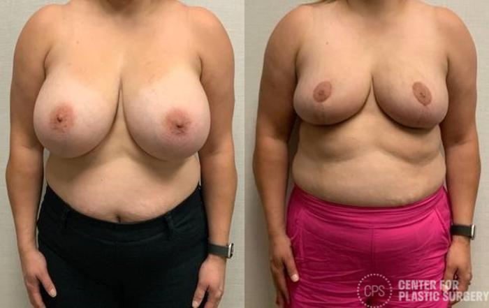 Breast Reconstruction Case 386 Before & After Front | Chevy Chase & Annandale, Washington D.C. Metropolitan Area | Center for Plastic Surgery