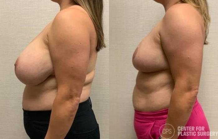 Breast Reconstruction Case 386 Before & After Left Side | Chevy Chase & Annandale, Washington D.C. Metropolitan Area | Center for Plastic Surgery