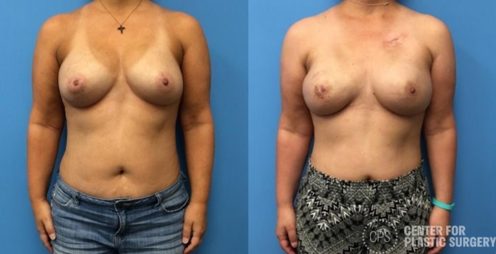 Breast Reconstruction Case 400 Before & After Front | Chevy Chase & Annandale, Washington D.C. Metropolitan Area | Center for Plastic Surgery