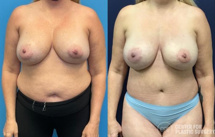 Breast Reconstruction Case 414 Before & After Front | Chevy Chase & Annandale, Washington D.C. Metropolitan Area | Center for Plastic Surgery
