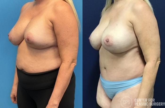 Breast Reconstruction Case 414 Before & After Left Oblique | Chevy Chase & Annandale, Washington D.C. Metropolitan Area | Center for Plastic Surgery