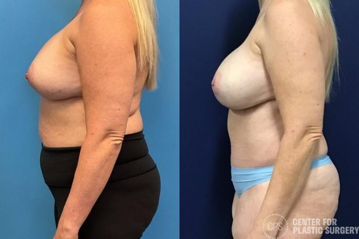 Breast Reconstruction Case 414 Before & After Left Side | Chevy Chase & Annandale, Washington D.C. Metropolitan Area | Center for Plastic Surgery