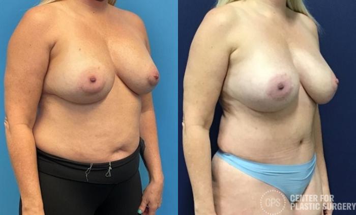 Breast Reconstruction Case 414 Before & After Right Oblique | Chevy Chase & Annandale, Washington D.C. Metropolitan Area | Center for Plastic Surgery