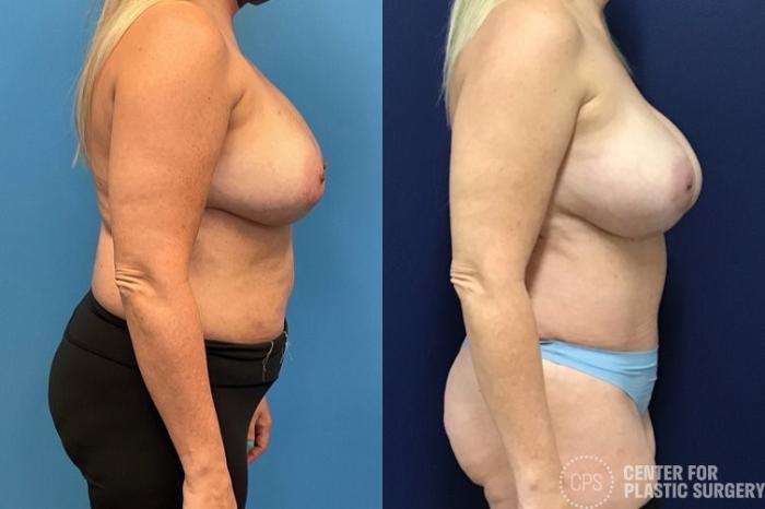 Breast Reconstruction Case 414 Before & After Right Side | Chevy Chase & Annandale, Washington D.C. Metropolitan Area | Center for Plastic Surgery