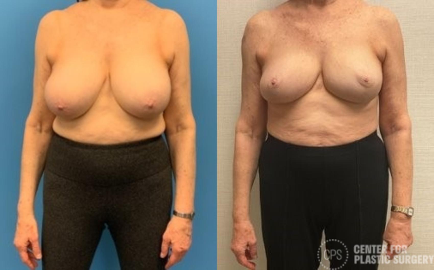 Breast Reduction Case 416 Before & After Front | Chevy Chase & Annandale, Washington D.C. Metropolitan Area | Center for Plastic Surgery