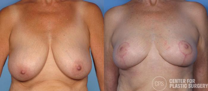 Breast Reduction Case 125 Before & After Front | Chevy Chase & Annandale, Washington D.C. Metropolitan Area | Center for Plastic Surgery
