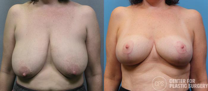 Breast Reduction Case 126 Before & After Front | Chevy Chase & Annandale, Washington D.C. Metropolitan Area | Center for Plastic Surgery