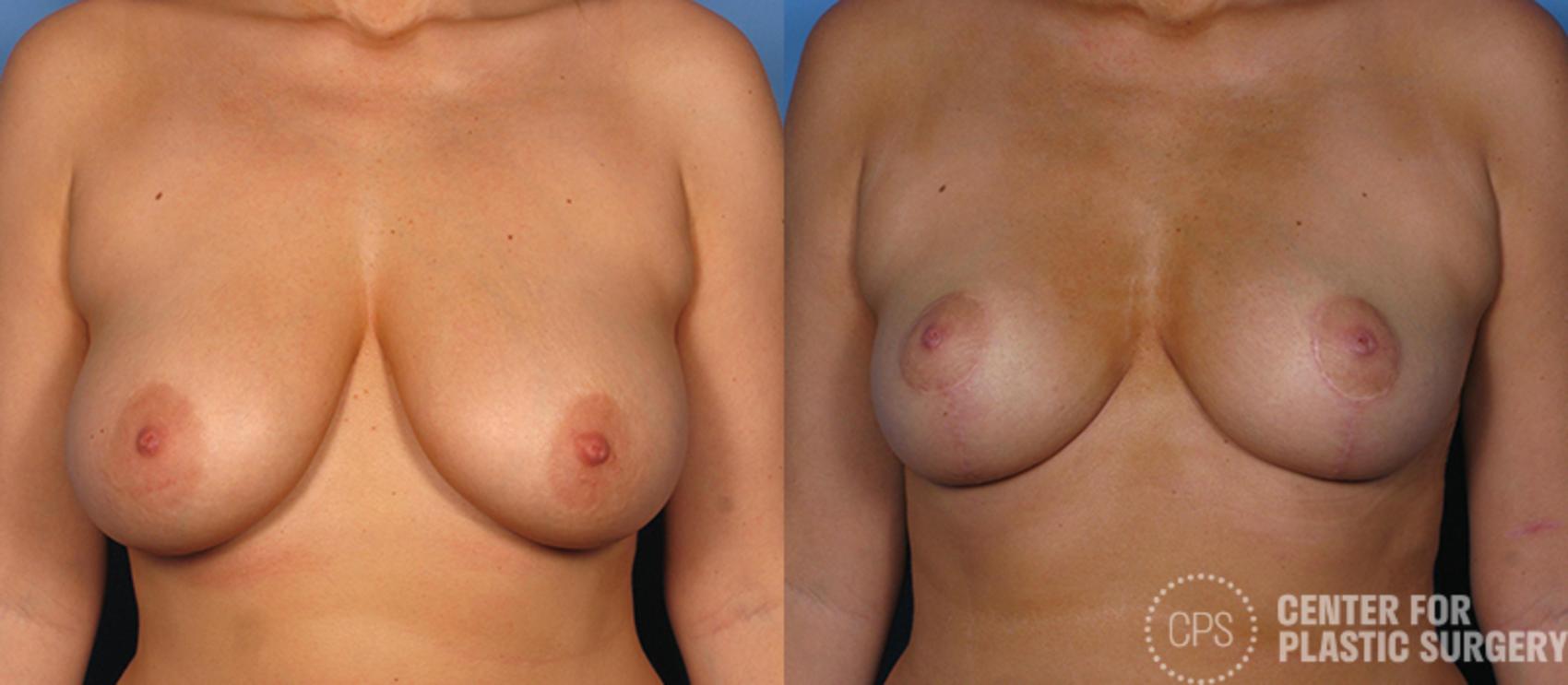 Breast Reduction Case 128 Before & After Front | Chevy Chase & Annandale, Washington D.C. Metropolitan Area | Center for Plastic Surgery