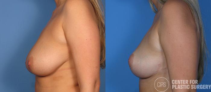 Breast Reduction Case 128 Before & After Left Side | Chevy Chase & Annandale, Washington D.C. Metropolitan Area | Center for Plastic Surgery