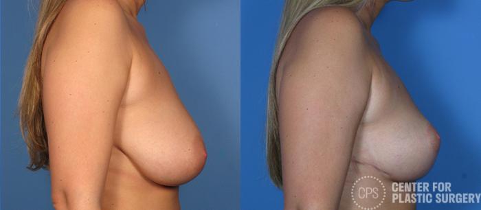 Breast Reduction Case 128 Before & After Right Side | Chevy Chase & Annandale, Washington D.C. Metropolitan Area | Center for Plastic Surgery
