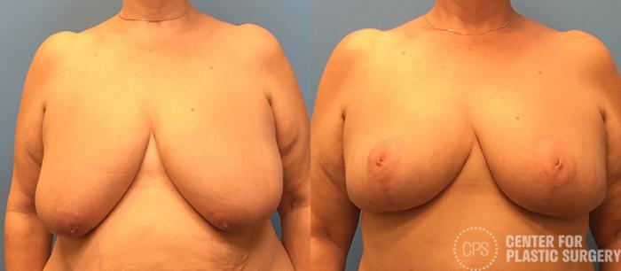 Breast Reduction Case 130 Before & After Front | Chevy Chase & Annandale, Washington D.C. Metropolitan Area | Center for Plastic Surgery
