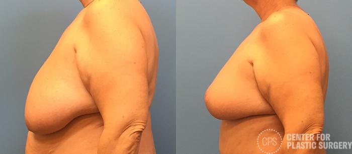Breast Reduction Case 130 Before & After Left Side | Chevy Chase & Annandale, Washington D.C. Metropolitan Area | Center for Plastic Surgery