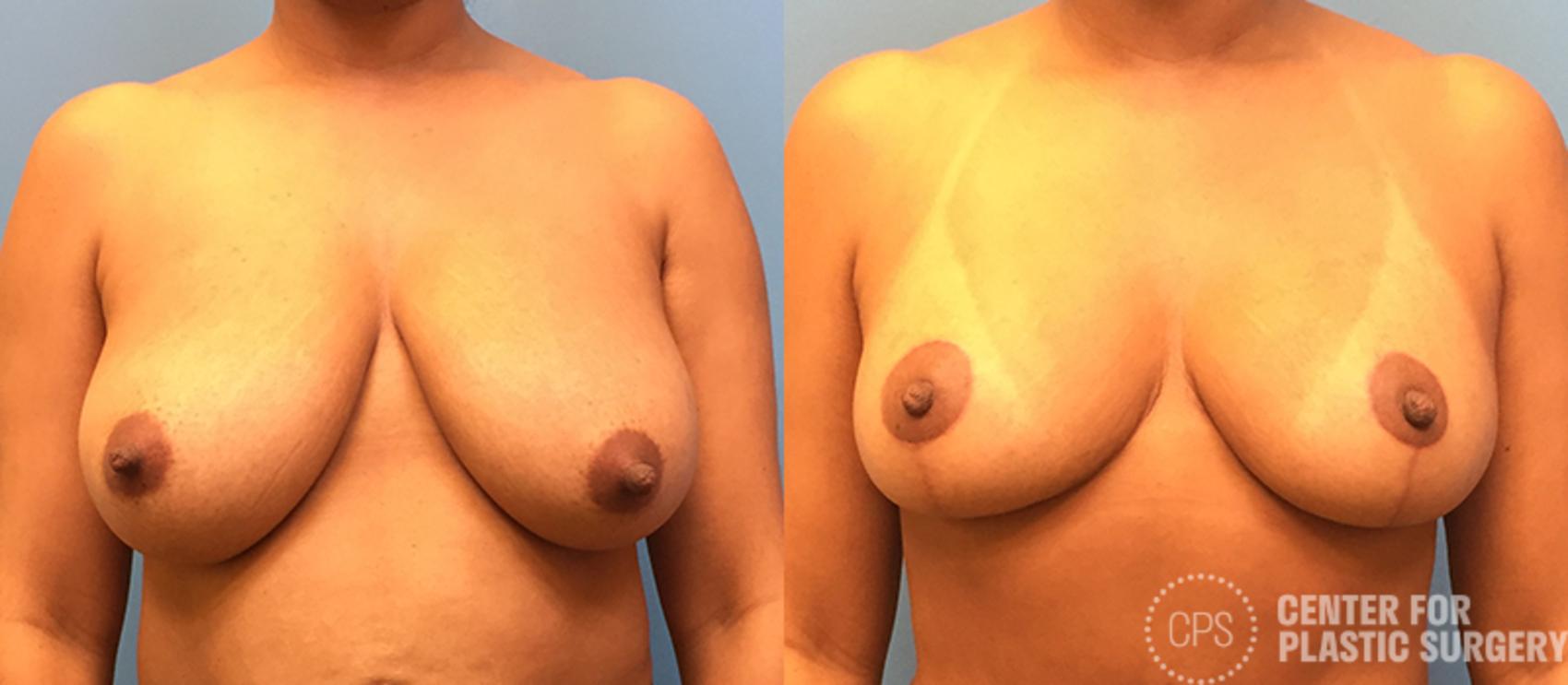Breast Reduction Case 131 Before & After Front | Annandale, Washington D.C. Metropolitan Area | Center for Plastic Surgery