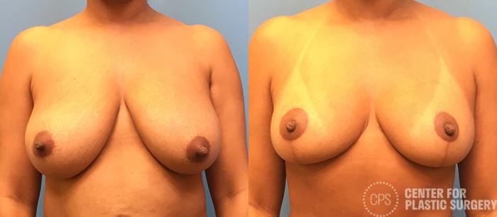 Breast Reduction Case 131 Before & After Front | Chevy Chase & Annandale, Washington D.C. Metropolitan Area | Center for Plastic Surgery