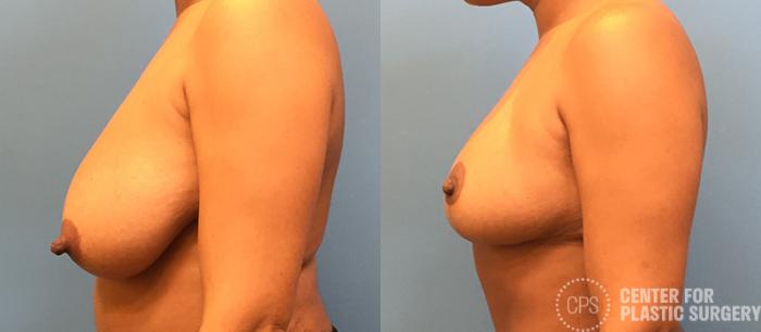 Breast Reduction Case 131 Before & After Left Side | Chevy Chase & Annandale, Washington D.C. Metropolitan Area | Center for Plastic Surgery