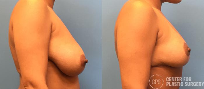 Breast Reduction Case 131 Before & After Right Side | Chevy Chase & Annandale, Washington D.C. Metropolitan Area | Center for Plastic Surgery