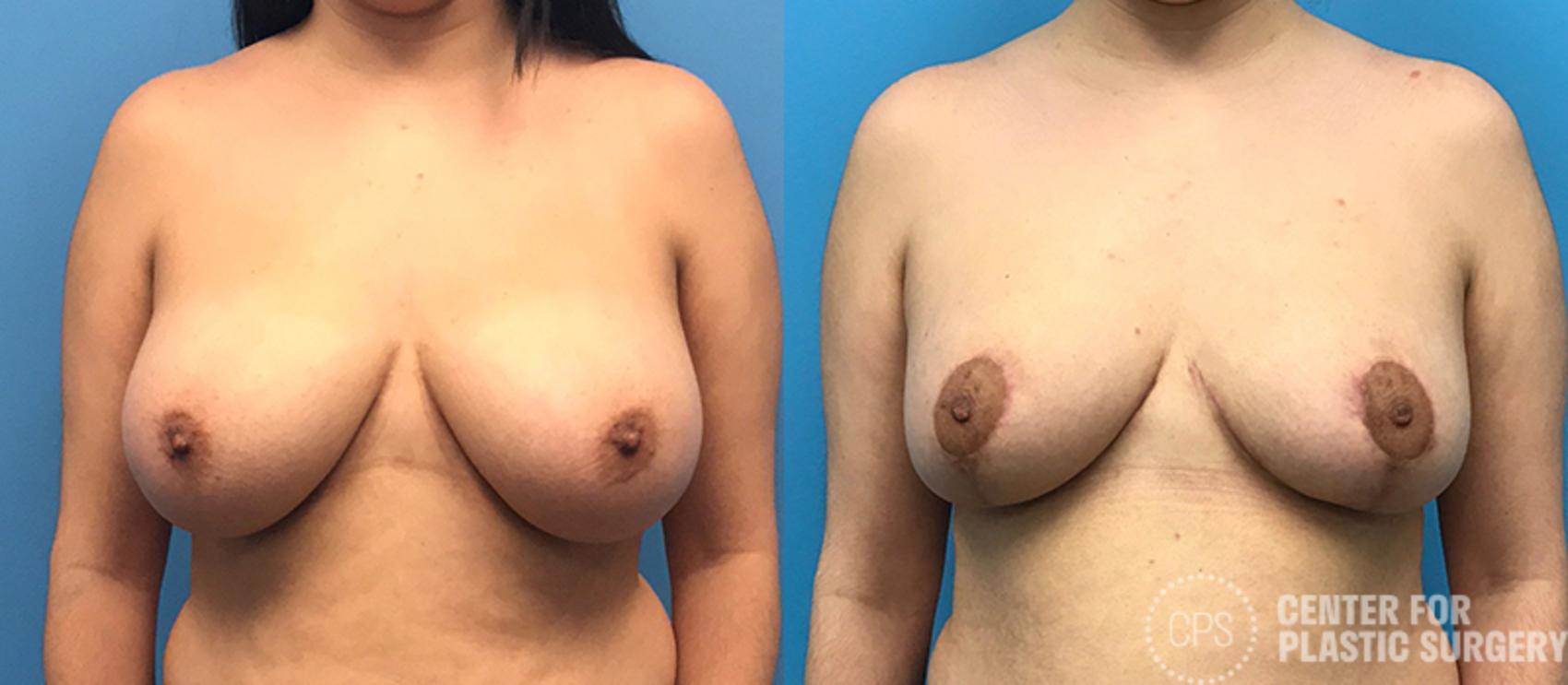 Breast Reduction Case 132 Before & After Front | Chevy Chase & Annandale, Washington D.C. Metropolitan Area | Center for Plastic Surgery