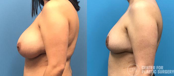 Breast Reduction Case 132 Before & After Left Side | Chevy Chase & Annandale, Washington D.C. Metropolitan Area | Center for Plastic Surgery
