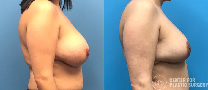 Breast Reduction Case 132 Before & After Right Side | Chevy Chase & Annandale, Washington D.C. Metropolitan Area | Center for Plastic Surgery