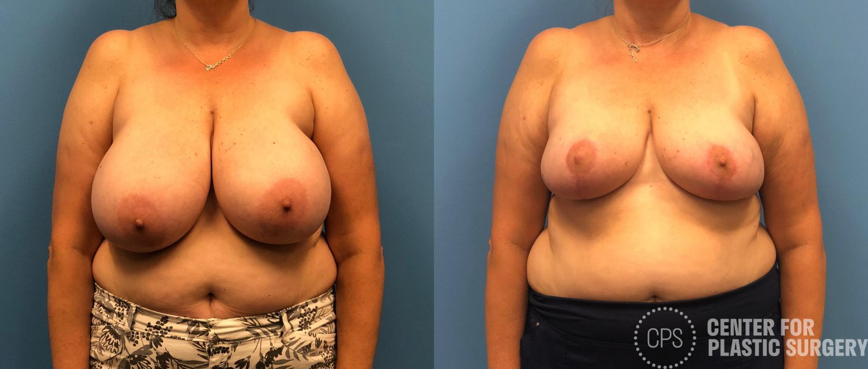 Breast Reduction Case 156 Before & After Front | Annandale, Washington D.C. Metropolitan Area | Center for Plastic Surgery