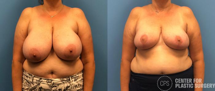 Breast Reduction Case 156 Before & After Front | Chevy Chase & Annandale, Washington D.C. Metropolitan Area | Center for Plastic Surgery