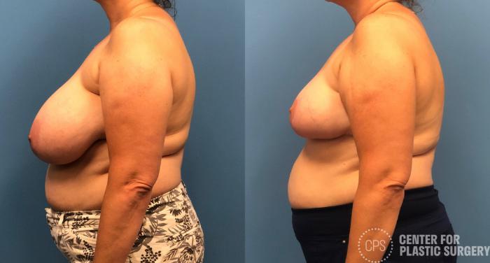 Breast Reduction Case 156 Before & After Left Side | Chevy Chase & Annandale, Washington D.C. Metropolitan Area | Center for Plastic Surgery