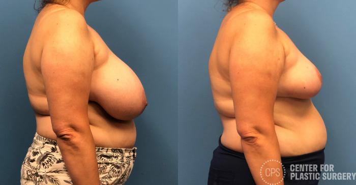 Breast Reduction Case 156 Before & After Right Side | Chevy Chase & Annandale, Washington D.C. Metropolitan Area | Center for Plastic Surgery