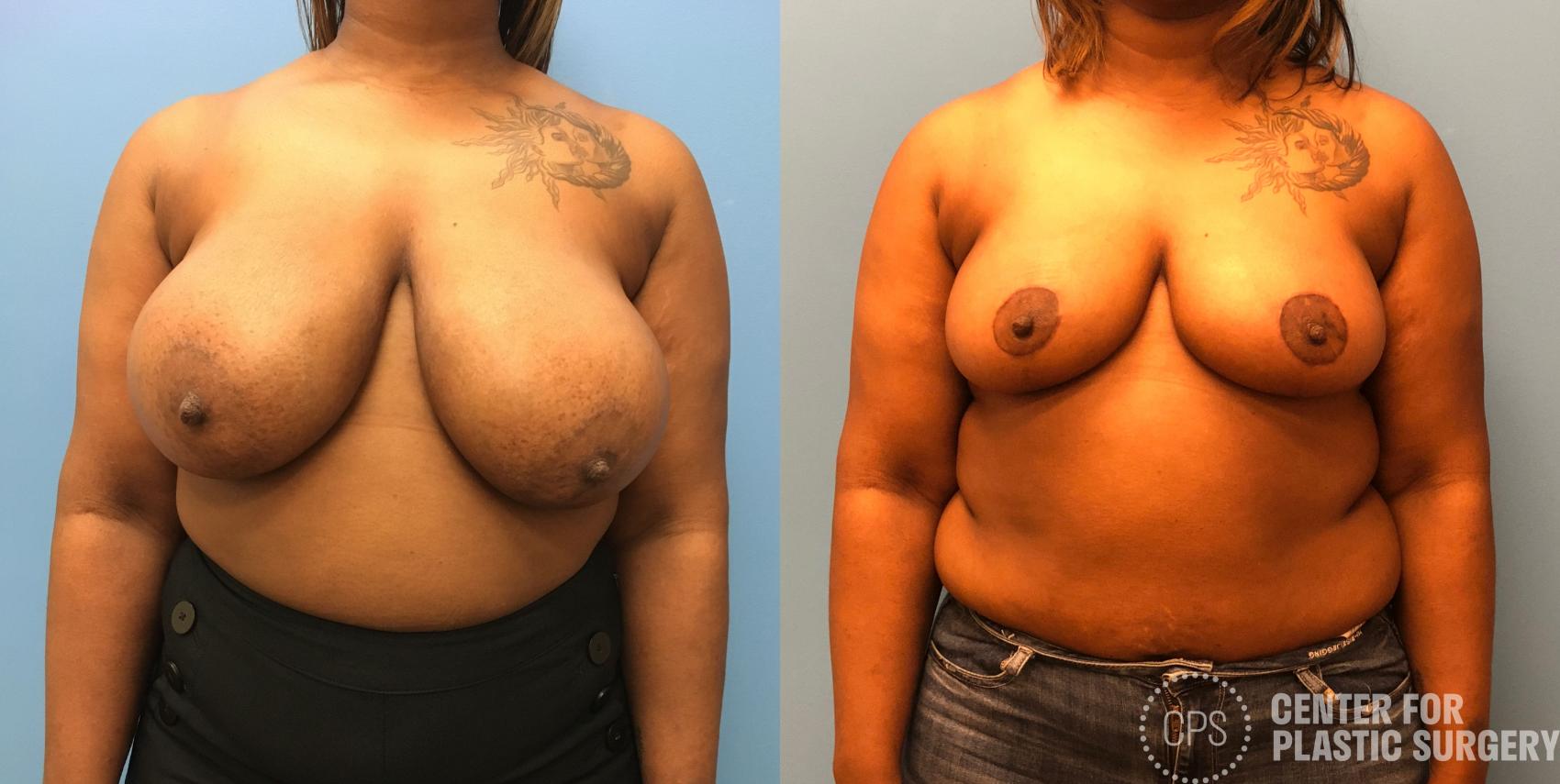 Breast Reduction Case 171 Before & After Front | Chevy Chase & Annandale, Washington D.C. Metropolitan Area | Center for Plastic Surgery