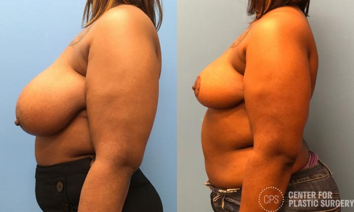 Breast Reduction Case 171 Before & After Left Side | Chevy Chase & Annandale, Washington D.C. Metropolitan Area | Center for Plastic Surgery