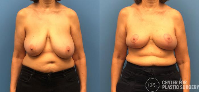 Breast Reduction Case 172 Before & After Front | Chevy Chase & Annandale, Washington D.C. Metropolitan Area | Center for Plastic Surgery