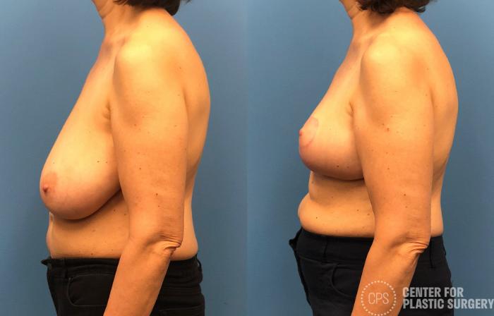 Breast Reduction Case 172 Before & After Left Side | Chevy Chase & Annandale, Washington D.C. Metropolitan Area | Center for Plastic Surgery
