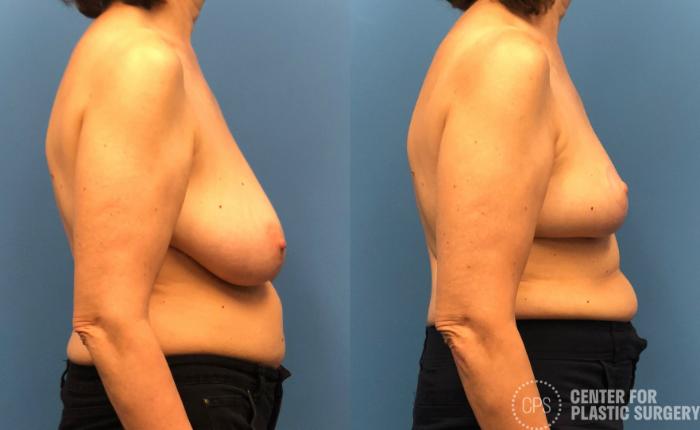 Breast Reduction Case 172 Before & After Right Side | Chevy Chase & Annandale, Washington D.C. Metropolitan Area | Center for Plastic Surgery