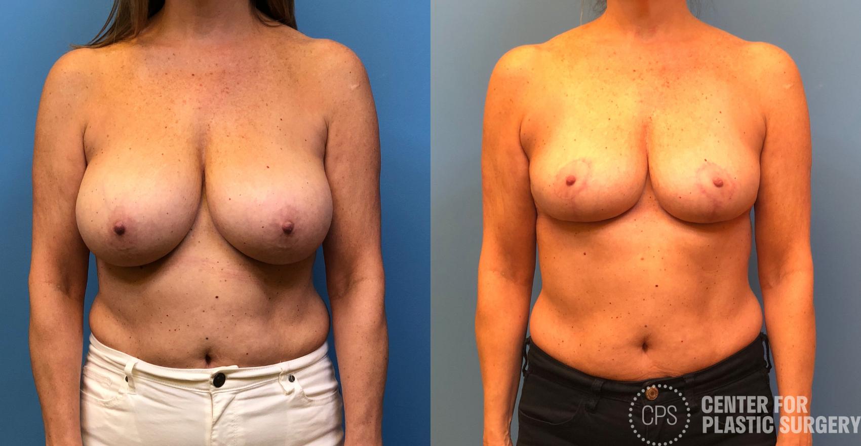 Breast Reduction Case 176 Before & After Front | Chevy Chase & Annandale, Washington D.C. Metropolitan Area | Center for Plastic Surgery
