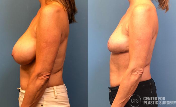 Breast Reduction Case 176 Before & After Left Side | Chevy Chase & Annandale, Washington D.C. Metropolitan Area | Center for Plastic Surgery