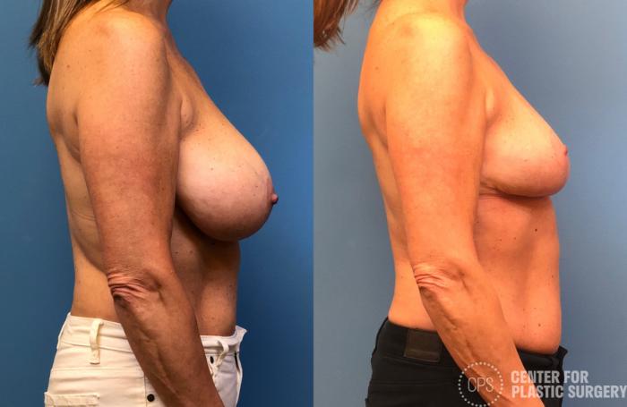Breast Reduction Case 176 Before & After Right Side | Chevy Chase & Annandale, Washington D.C. Metropolitan Area | Center for Plastic Surgery