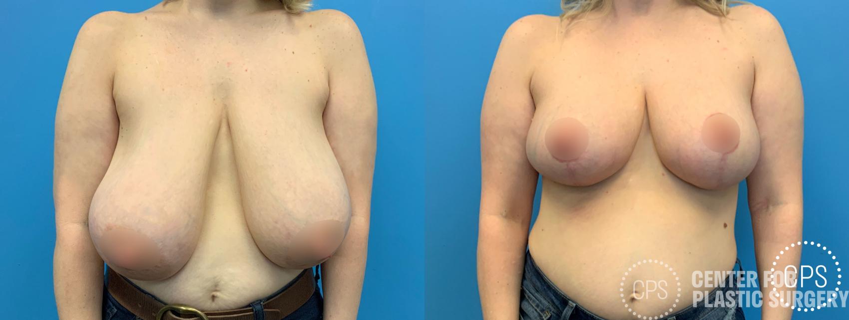 Breast Reduction Case 199 Before & After Front | Chevy Chase & Annandale, Washington D.C. Metropolitan Area | Center for Plastic Surgery