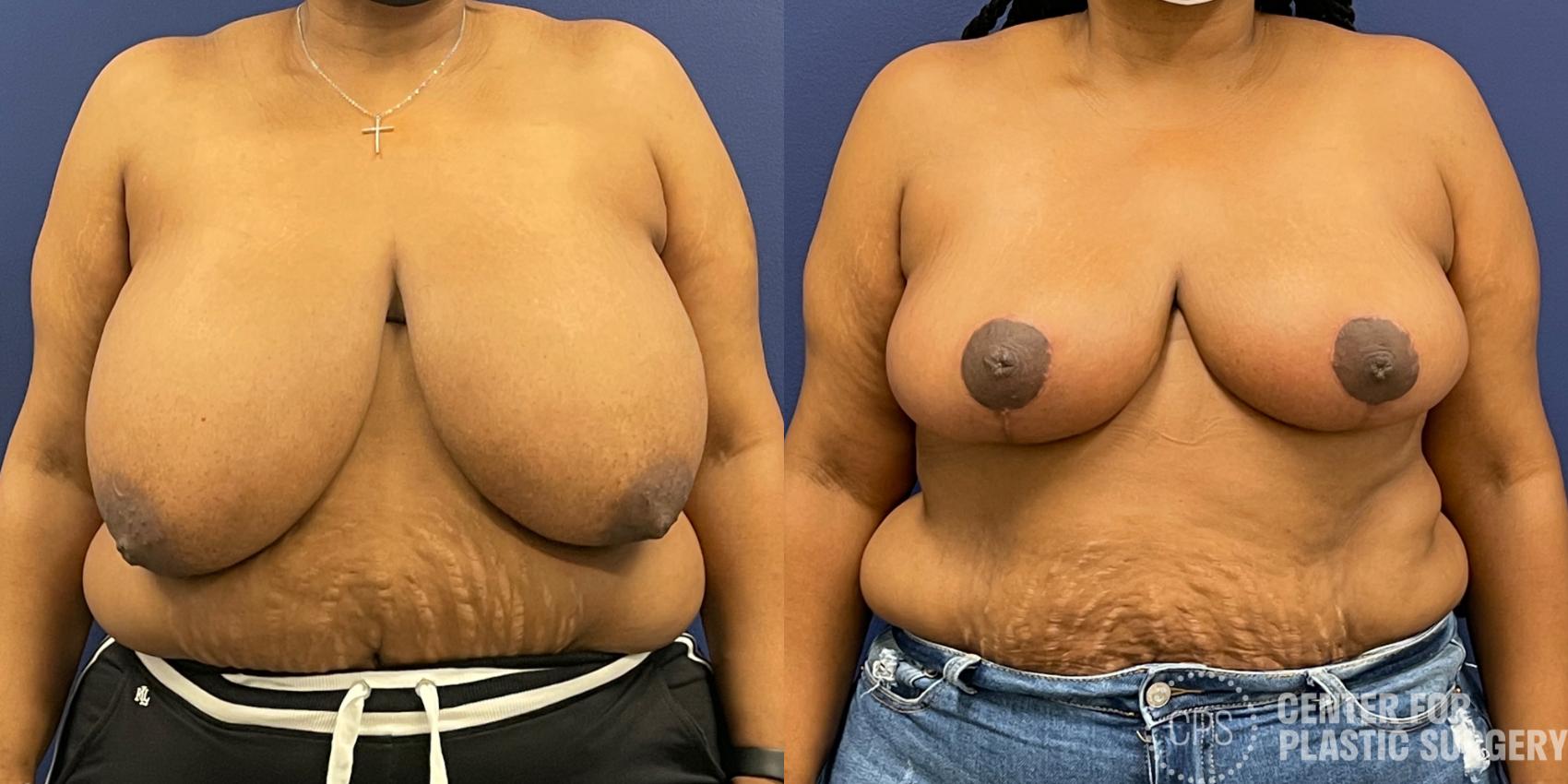 Breast Reduction Case 206 Before & After Front | Chevy Chase & Annandale, Washington D.C. Metropolitan Area | Center for Plastic Surgery