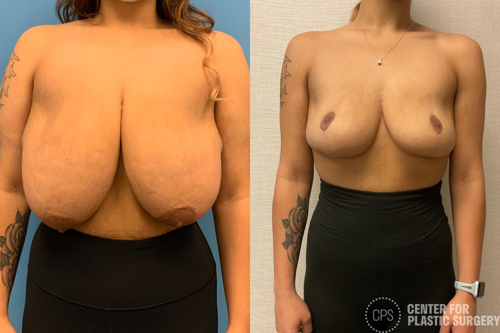 Breast Reduction Case 212 Before & After Front | Chevy Chase & Annandale, Washington D.C. Metropolitan Area | Center for Plastic Surgery