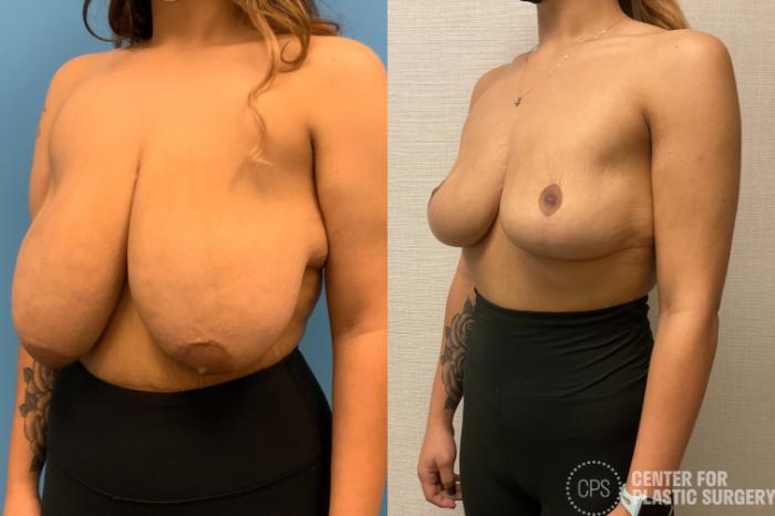 Breast Reduction Case 212 Before & After Left Oblique | Chevy Chase & Annandale, Washington D.C. Metropolitan Area | Center for Plastic Surgery