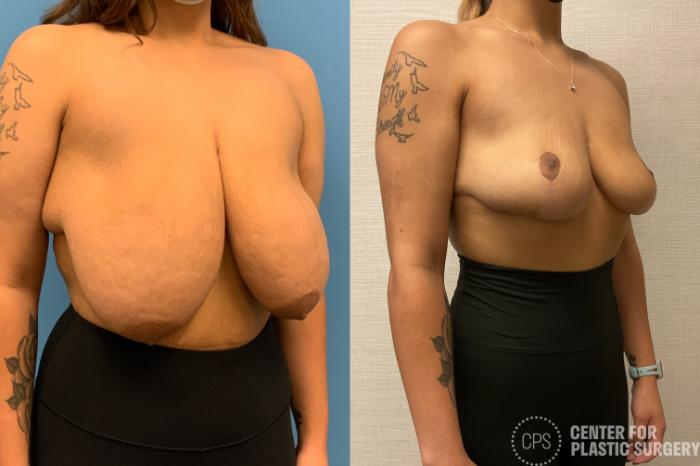 Breast Reduction Case 212 Before & After Right Oblique | Chevy Chase & Annandale, Washington D.C. Metropolitan Area | Center for Plastic Surgery