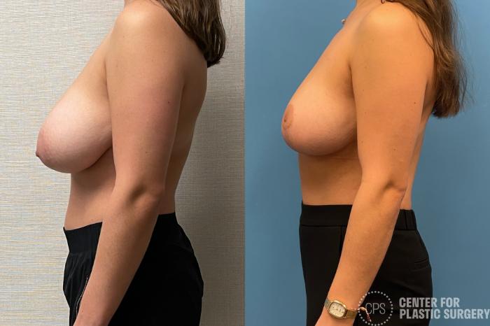 Breast Reduction Case 217 Before & After Left Side | Chevy Chase & Annandale, Washington D.C. Metropolitan Area | Center for Plastic Surgery