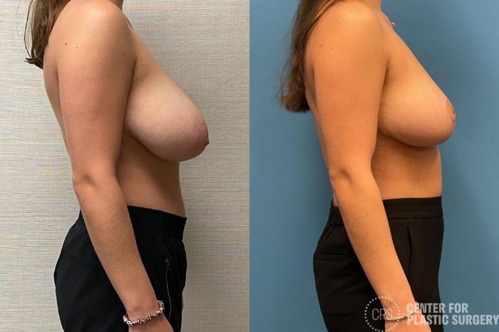 Breast Reduction Case 217 Before & After Right Side | Chevy Chase & Annandale, Washington D.C. Metropolitan Area | Center for Plastic Surgery