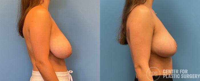 Breast Reduction Case 239 Before & After Right Side | Chevy Chase & Annandale, Washington D.C. Metropolitan Area | Center for Plastic Surgery