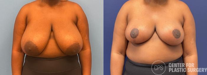Breast Reduction Case 240 Before & After Front | Chevy Chase & Annandale, Washington D.C. Metropolitan Area | Center for Plastic Surgery